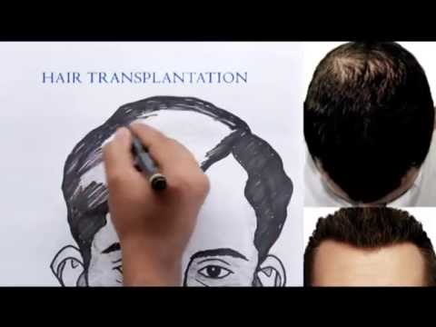 Curls & Curves Hair Transplantation & Cosmetic Surgery Centre: Ad Film