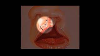 Noordhoff's Vermilion Z Plasty