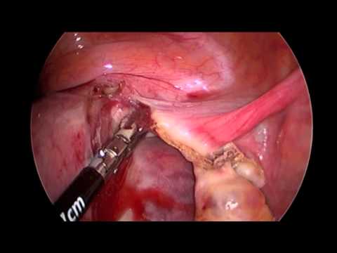 L'hystérectomie laparoscopique par incision unique.