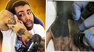 REMOÇÃO de TATUAGEM com LASER