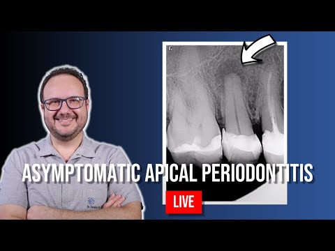 Endo Treatment of Asyntomatic Apical Periodontitis of 15 - Part 1