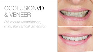 Full Mouth Rehabilitation & Lifting Of The Vertical Dimension