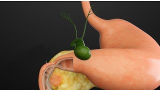 Antroduodenal Stenting in gastric cancer with gastric outlet obstruction