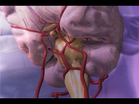 Subarachnoid Hemorrhage