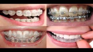 preview picture of video 'Braces Round Lake Beach IL - Orthodontics Round Lake Beach IL - Round Lake Beach IL Orthodontist'