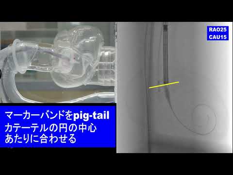 TAVI Evolut Pro Cusp Overlap