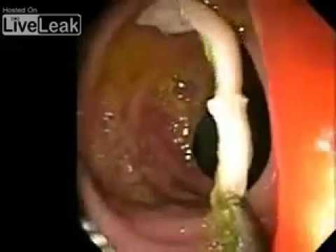 A pinworms helminták kezelése