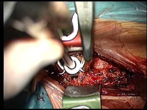 Essen in der Kniearthrose Behandlung von Volksmedizin Die Kissen sind nützlich in Osteochondrose