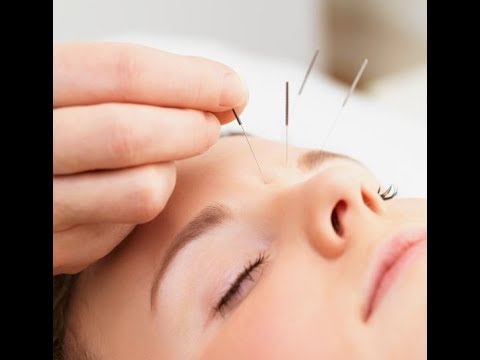 Acupuncture treatment for stress and anxiety