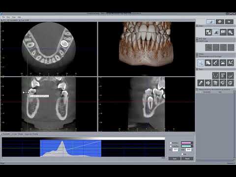 Morita i Dixel OneVolumenViewer Funciones básicas