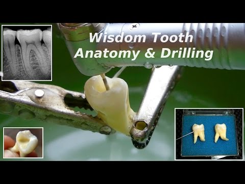 Third Molar (Wisdom Tooth) Anatomy & Drilling Video