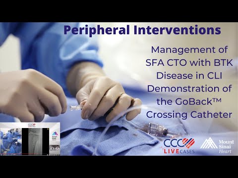 Management of SFA CTO with BTK Disease in CLI Demonstration of the GoBack™ Crossing Catheter