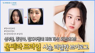 심부볼, 중안부, 팔자주름 바로 개선!!! | 울쎄라 프라임 시술 브이로그