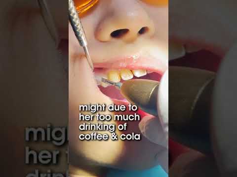 Severe Teeth Stain Removal