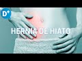 Hernia de hiato: Causas, síntomas y tratamiento de la hernia de hiato Hernia de hiato: Causas, síntomas y tratamiento de la hernia de hiato