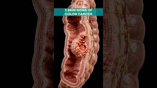 5 Skin Signs That May Be Linked to Colon Cancer 🚨