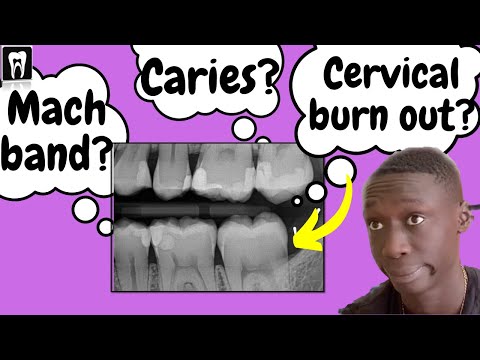 Caries Vs Cervical Burnout Vs Mach Band Effect | Interpretation of Dental Caries