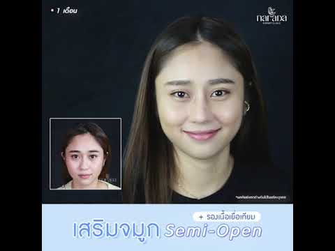 ทรงจมูกสวย เข้ากับใบหน้า ด้วยเทคนิค Semi-Open+รองเนื้อเยื่อเทียม ที่ นารดาคลินิก ทรงจมูกสวย เข้ากับใบหน้า ด้วยเทคนิค Semi-Open+รองเนื้อเยื่อเทียม ที่ นารดาคลินิก