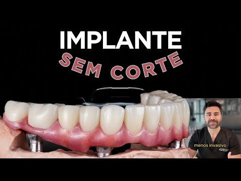 Implante Sem Corte - Implante Dentário Minimamente Invasivo
