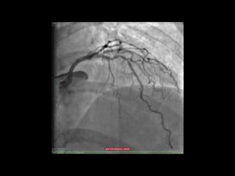 Iatrogenic left main Dr.Khaled Sleik