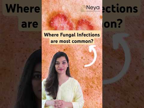 Causes of fungal skin infections | Fungal  infection on skin | Skin Doctor in Hyderabad