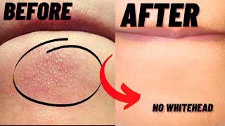 How To Remove Whiteheads And Blackheads From Chin At Home