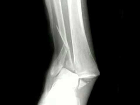 足の脱臼 – 脱臼の概要、症状、治療方法