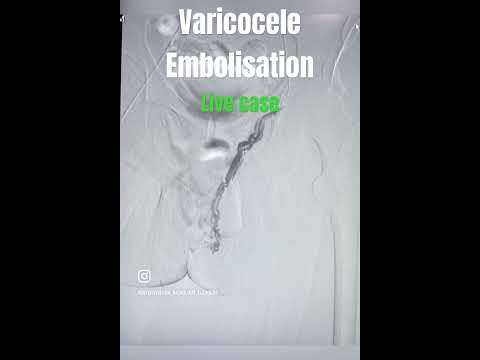 Best Varicocele treatment in lucknow - intervention radiology medanta - no cut , no scar