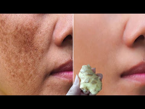 How To Get Rid Of Dark Spots On Face \\ Banana &...