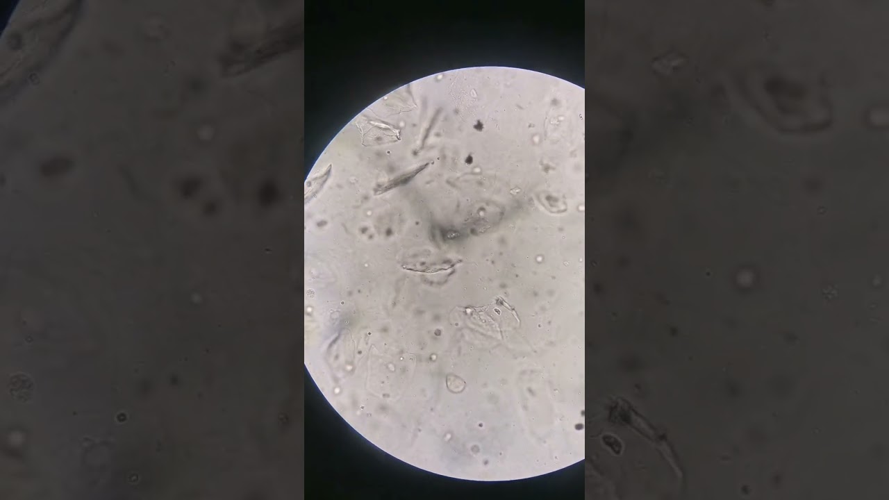 Urine sample: WBC above normal #laboratory #mls #cls #medtechstudent #microscope #medtech #urine