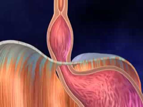 comment soigner une hernie hiatale