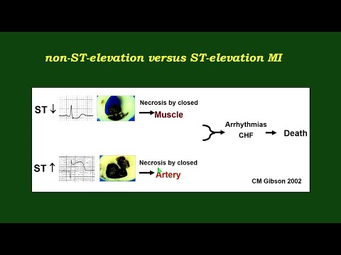 Pathophysiology of Perioperative Myocardial Injury and Infarction