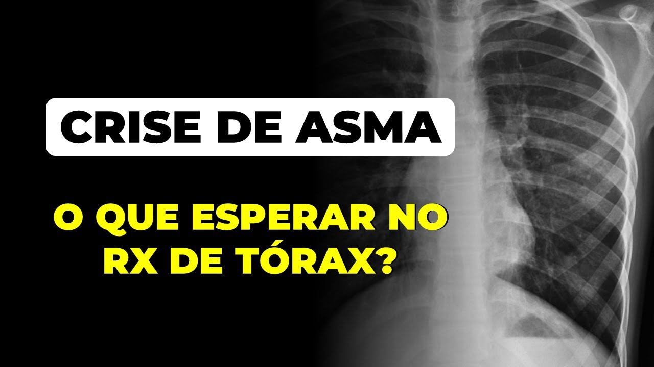 Crise de asma: o que esperar no RX de tórax