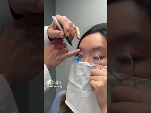 Fitting A Scleral Lens With Eyeprint Pro! #keratoconus #eyedoctor #dryeyes #contactlenses