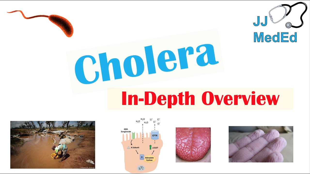 Cholera (Vibrio Cholerae) Pathophysiology, Risk Factors, Symptoms, Diagnosis, and Treatment