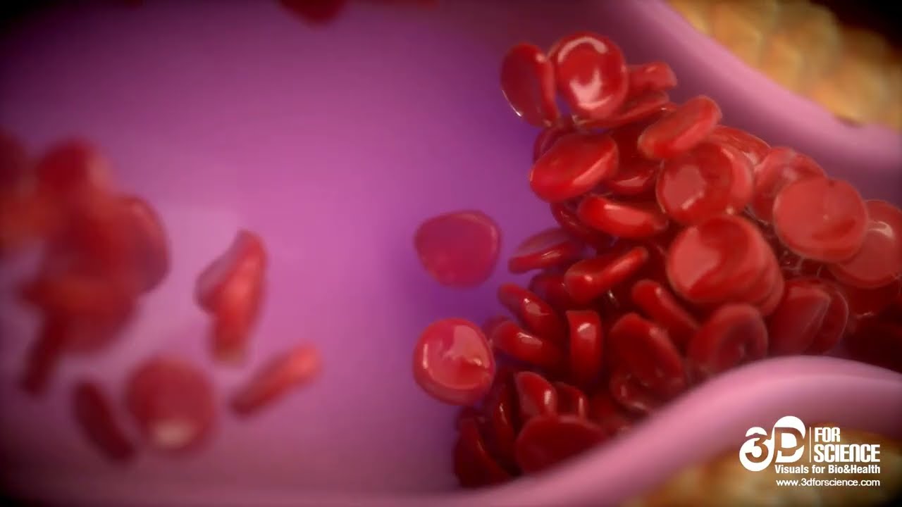 3D atherosclerosis - 3DforScience