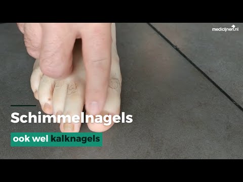 Schimmelnagels