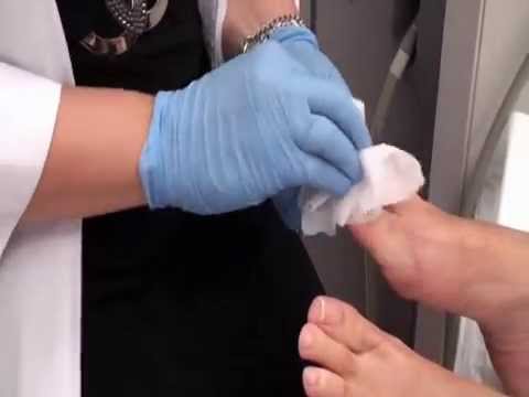 comment traiter les champignons des ongles