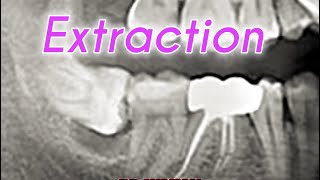 Horizontal Wisdom Tooth Extraction 