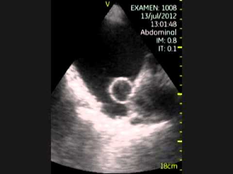 Biobsiya mit Prostata Operation des Prostata-Adenom in Minsk