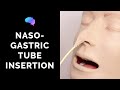 Nasogastric (NG) Tube Insertion - OSCE Guide | UKMLA | CPSA