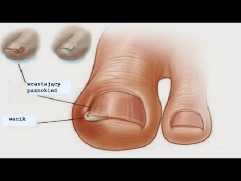 Dlaczego boli kość po stronie stóp Koślawego Pro Plus Mińsk