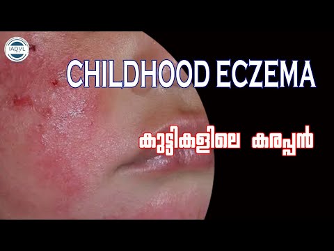 childhood eczema കുട്ടികളിലെ എക്‌സിമ കാരണങ്ങളും പ്