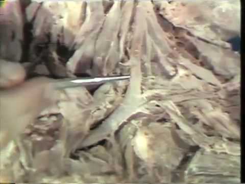 Subclavian Artery and Visceral Section of Neck