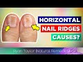 Horizontal Ridges On Nails? (Cause)