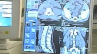 CT Scan Radiation Draws more Concern