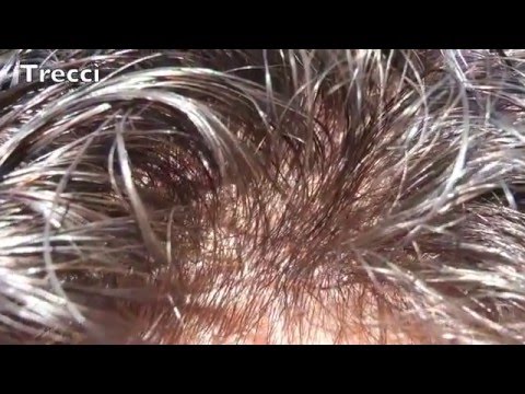 Trattamento dellimpotenza nel diabete di tipo 1 Agenti femmina atti reali