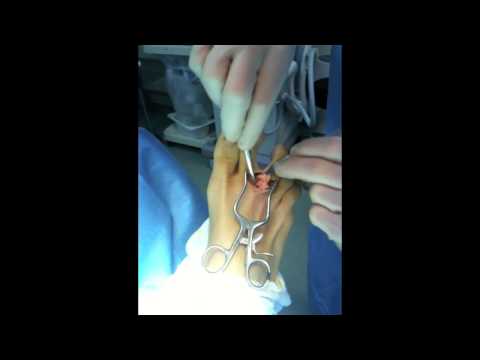 Neuroma Surgery