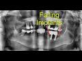 Who is at Risk of Losing Dental Implants? What Treatment Options are There if the Implant is Failing