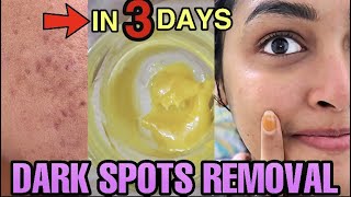 Remove DARK SPOTS NATURALLY in 3 Days 😍 Hyperpigmentation, Acne Scars, Brown Spots